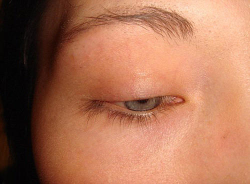 نجاح اول عملية زرع رموش لفتاة بريطانية!! نجاح اول عملية زرع رموش لفتاة بريطانية!!