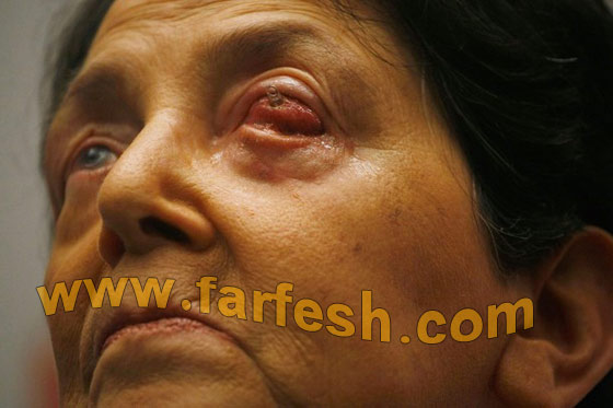 تستعيد بصرها بعد زراعة سن في عينها!!! تستعيد بصرها بعد زراعة سن في عينها!!!