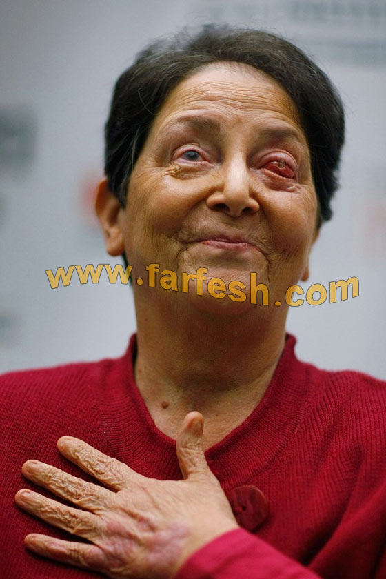 تستعيد بصرها بعد زراعة سن في عينها!!! تستعيد بصرها بعد زراعة سن في عينها!!!