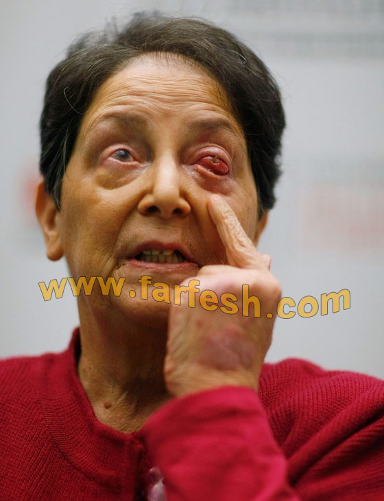 تستعيد بصرها بعد زراعة سن في عينها!!! تستعيد بصرها بعد زراعة سن في عينها!!!