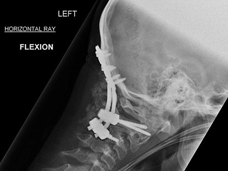 تعافي شاب انفصلت رقبته عن جسده تعافي شاب انفصلت رقبته عن جسده