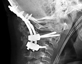 تعافي شاب انفصلت رقبته عن جسده 