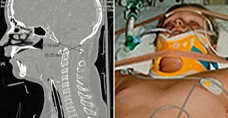 تعافي شاب انفصلت رقبته عن جسده تعافي شاب انفصلت رقبته عن جسده