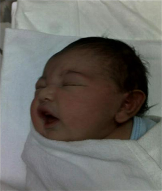 حالة ولادة نادرة على مستوى العالم لطفلة ترعرعت خارج رحم الام!