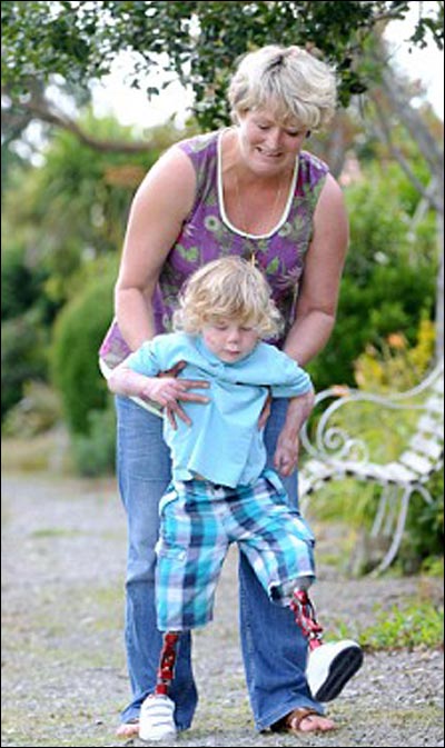 مؤثر جدا.. رحلة طفل بريطاني منذ قطع ساقيه حتى المشي مجددا