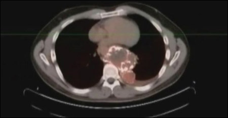 مرعب:أمريكي يكتشف ورم سرطاني بحجم كرة قدم في ظهره!