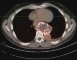 مرعب: رجل يكتشف ورما سرطانيا بحجم كرة قدم في ظهره! 