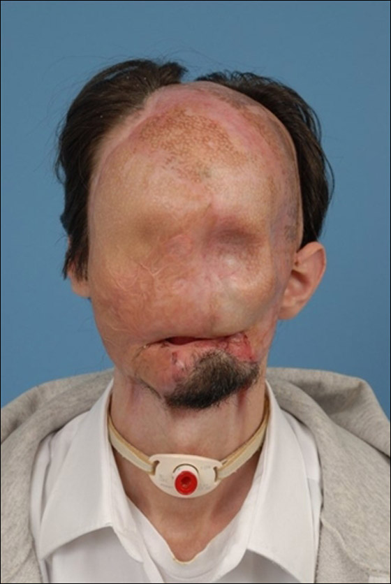 لأول مرة في الطب الامريكي: عملية نقل كامل للوجه تتم بنجاح!!