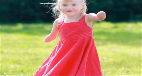 طفلة مبتورة الاطراف تساعد نظيرتها بالتاقلم مع وضعها الحالي