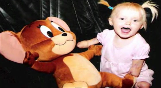 طفلة مبتورة الاطراف تساعد نظيرتها بالتاقلم مع وضعها الحالي