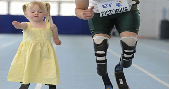 طفلة مبتورة الاطراف تساعد نظيرتها بالتاقلم مع وضعها الحالي