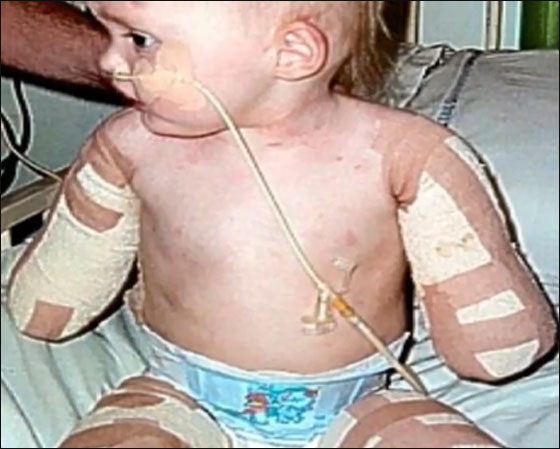 طفلة مبتورة الاطراف تساعد نظيرتها بالتاقلم مع وضعها الحالي