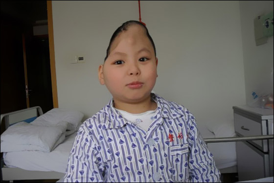 معجزة: عملية جراحية ناجحة تعيد تشكيل جمجمة طفل بنصف رأس!!