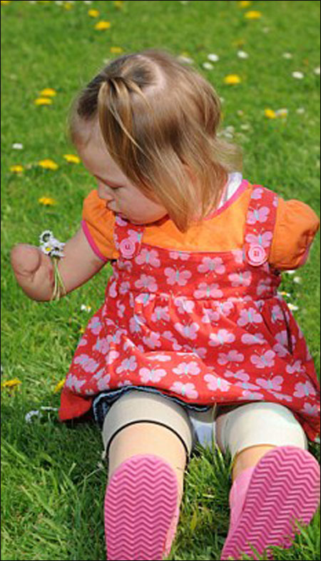 طفلة مبتورة الاطراف ترتدي حذائها المفضل مجددا بفضل ساقي الاميرة