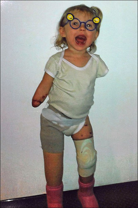 طفلة مبتورة الاطراف ترتدي حذائها المفضل مجددا بفضل ساقي الاميرة