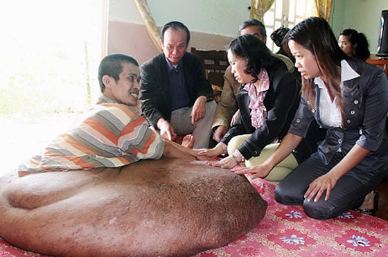 فيتنامي يعاني من أكبر ورم في العالم برجله يزن 80 كلغم
