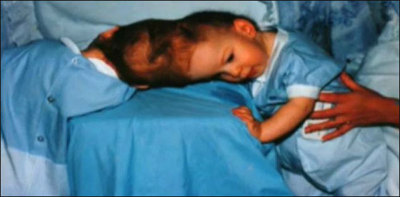 لاول مرة: توامان سياميان لا يريان بعضهما يرويان قصتهما 