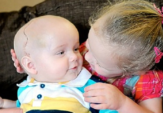 اطباء يحطمون جمجمة رضيع أُصيب بتشوه بارأس لانقاذ حياته!!