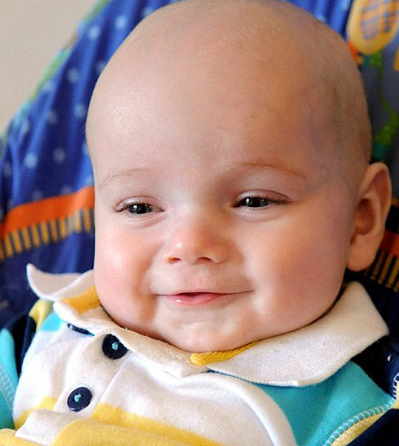 اطباء يحطمون جمجمة رضيع أُصيب بتشوه بارأس لانقاذ حياته!!