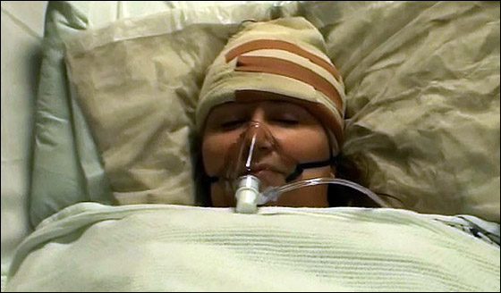 ظلت في كامل وعيها ومازحت الأطباء خلال عملية جراحية في دماغها!