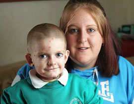 حالة نادرة: طفل ممنوع من اللمس كي لا تتحلل بشرته!! 