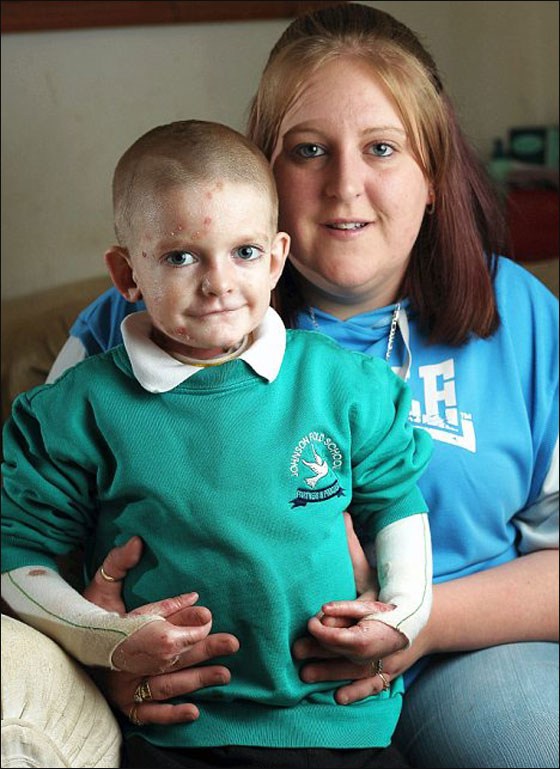 حالة نادرة: طفل ممنوع من اللمس كي لا تتحلل بشرته!! حالة نادرة: طفل ممنوع من اللمس كي لا تتحلل بشرته!!