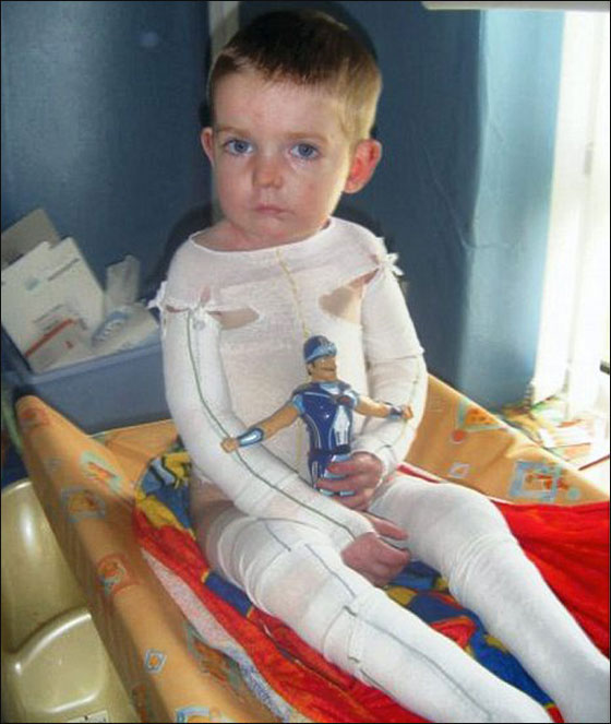 حالة نادرة: طفل ممنوع من اللمس كي لا تتحلل بشرته!! حالة نادرة: طفل ممنوع من اللمس كي لا تتحلل بشرته!!