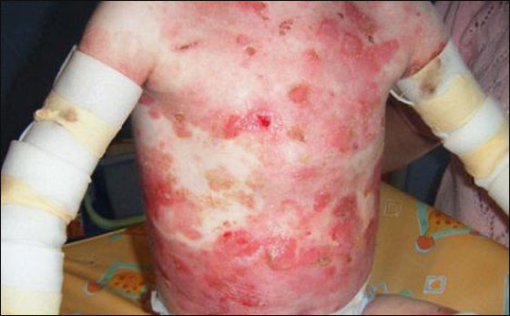 حالة نادرة: طفل ممنوع من اللمس كي لا تتحلل بشرته!! حالة نادرة: طفل ممنوع من اللمس كي لا تتحلل بشرته!!