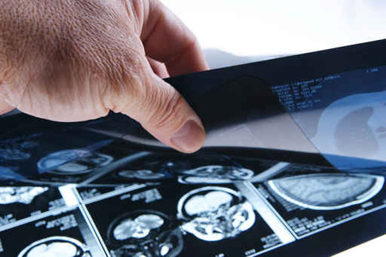 تحديد الاورام الدماغية بعد ان تشع!