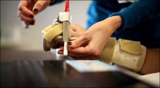 بالفيديو.. نجاح عملية زرع يدين لامرأة في الـ28 من العمر