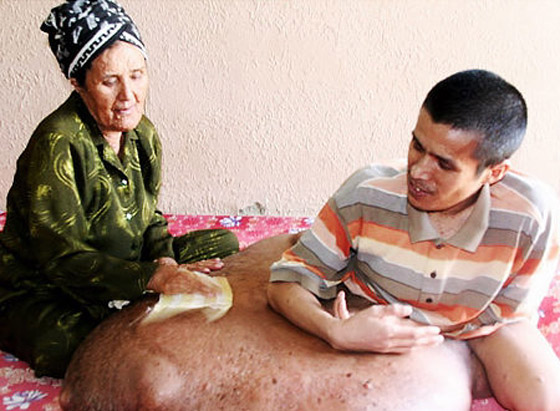 بعد ان خرج نموه عن السيطرة.. استئصال ورم هائل من ساق رجل!