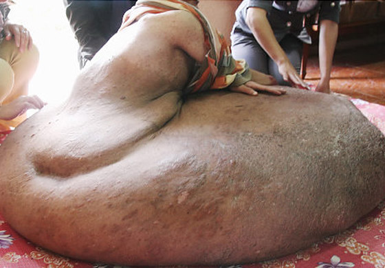 بعد ان خرج نموه عن السيطرة.. استئصال ورم هائل من ساق رجل!