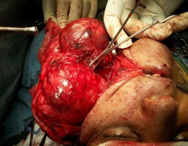 استئصال ورم يزن كيلو ونصف بنجاح من وجه امرأة سعودية!