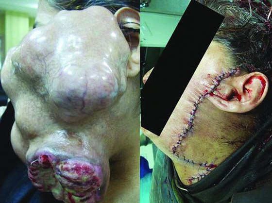 استئصال ورم يزن كيلو ونصف بنجاح من وجه امرأة سعودية!