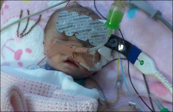 الطفلة ياسمين اصغر شخص يجري جراحة القلب المفتوح في العالم!