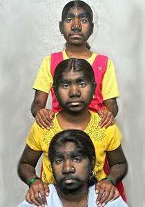 مؤثر.. قصة ثلاث شقيقات هنديات يعانين من متلازمة الذئب! 