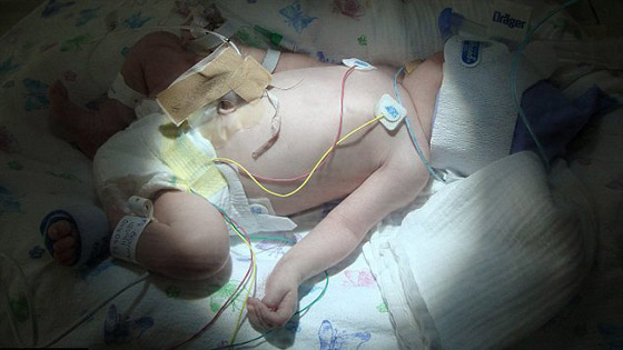 حالة طبية استثنائية.. طفلة تولد بدون دم وتنجو باعجوبة!