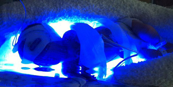 حالة طبية استثنائية.. طفلة تولد بدون دم وتنجو باعجوبة!