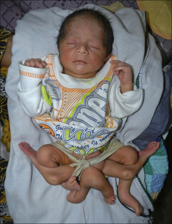 باكستان: ولادة رضيع بـ 6 أرجل وصحته جيدة!