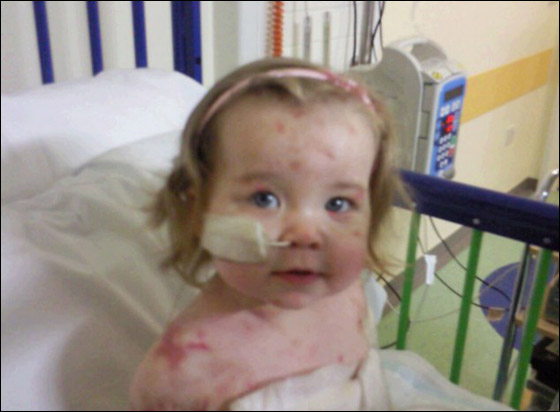 طفلة تخطو خطواتها للمرة الاولى بعد اسئصال جميع اطرافها