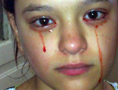 طفلة تبكي دما لتعرضها لضربة قبل نصف سنة والاهل يطلبون المساعدة 