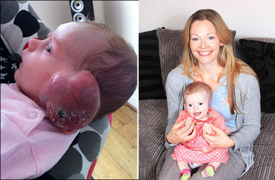 "وحمة" تتحول الى ورم سرطاني عملاق في وجه طفلة تبلغ 4 اشهر!!