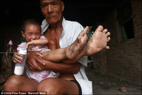 طفلة 3 سنوات ممنوعة من ارتداء الاحذية بسبب كبر قدميها!