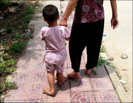 طفلة 3 سنوات ممنوعة من ارتداء الاحذية بسبب كبر قدميها!